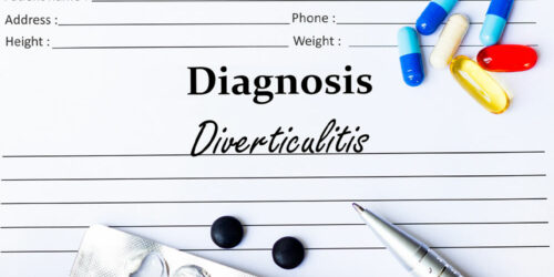 Diverticulitis – Causes, Symptoms, and How to Manage the Condition