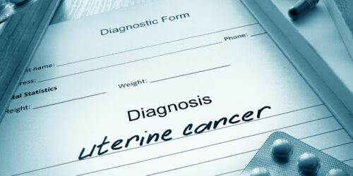 Uterine Cancer – Its Causes, Symptoms, and Stages