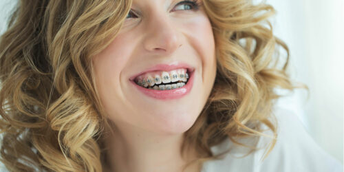 A guide to adult braces