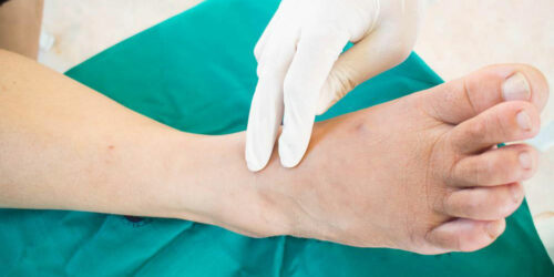 Neuropathy – An Overview