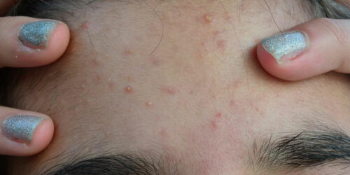 5 Popular Acne Products for Smooth and Clear Skin