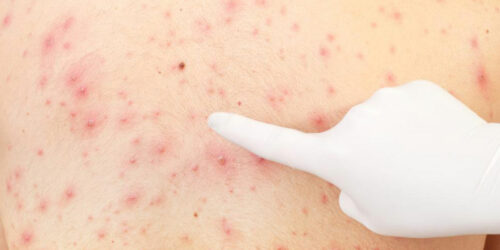 All You Need to Know About Pityriasis Rosea Treatments