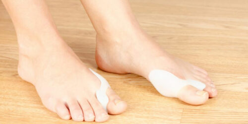 Bunion Treatment – All You Need to Know