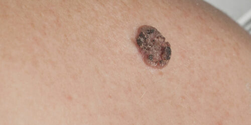 Carcinoma – Types, symptoms, and other important information you should know