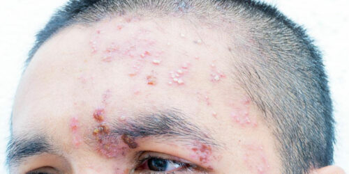 Causes and Treatments for Nerve Pain from Shingles