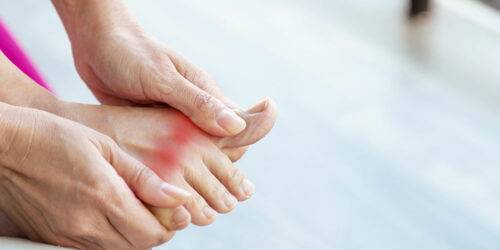 Gout – Diagnosis, stages, and prevention