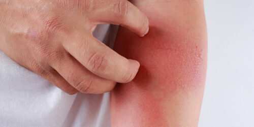 Here’s How to Identify a Skin Rash