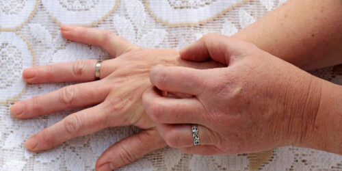 Here’s how you can identify and prevent scabies skin rash