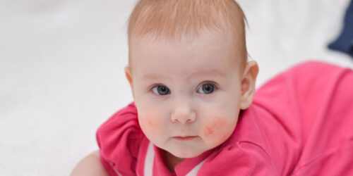 Important Things You Need to Know about Eczema