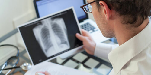 Pneumonia – Symptoms, Causes, Risk Factors, and Diagnosis