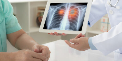 The look into the stages of lung cancer