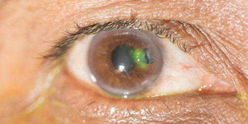 Various eye diseases and their symptoms