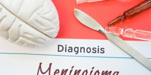 Meningioma – Symptoms, Causes, Diagnosis, and More