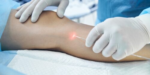 Understanding Varicose Vein Specialists: Expertise, Treatments, and Patient Care